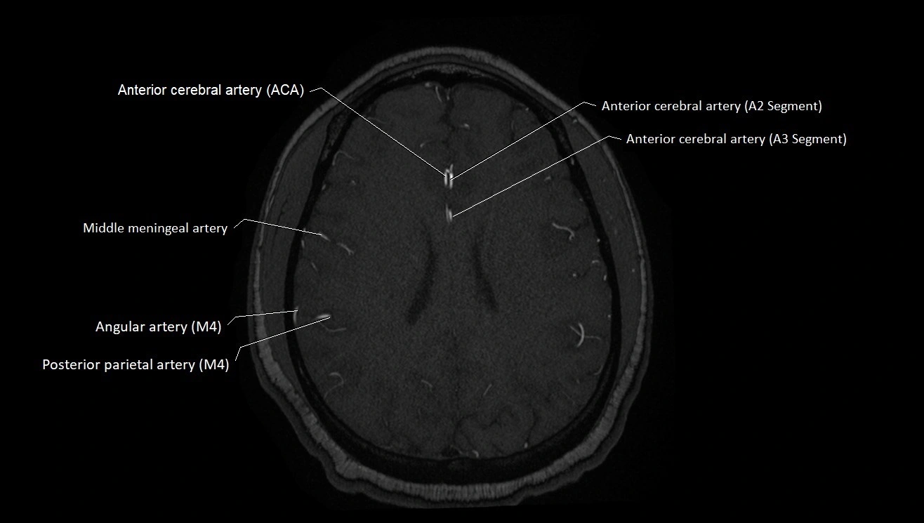 MRA brain (cerebral arteries) anatomy axial 3T image 40.webp